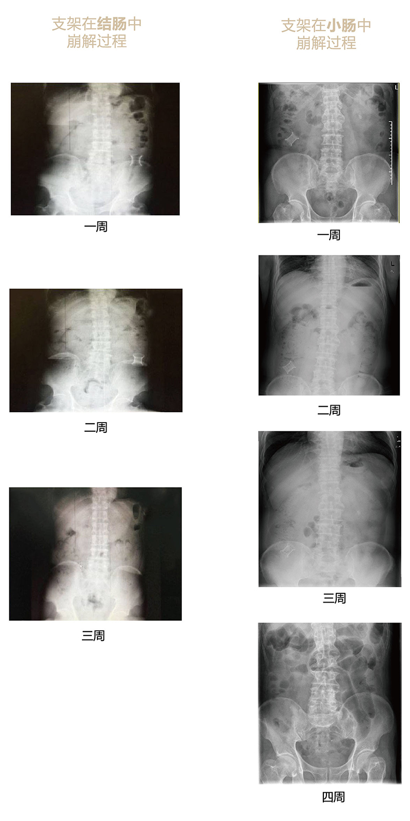 手術崩解過程x光片-01.jpg